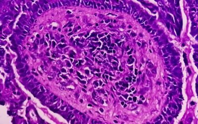 Evaluated Impact of Triptorelin Peptide in Endometriosis and Cancer Studies